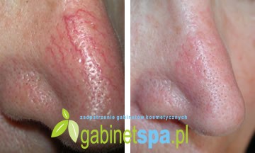 ND-YAG LASER для закрытия судов мезолазер