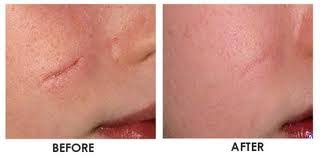 Revitol Scar Cream от старых шрамов и растяжек ШАНС!